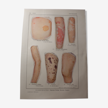 Planche médicale anatomie pityriasis
