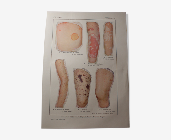 Planche médicale anatomie pityriasis