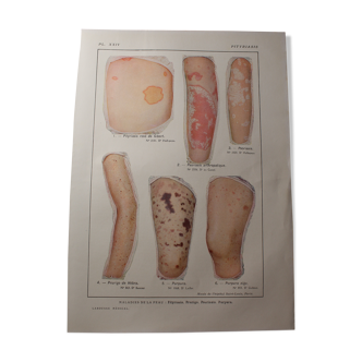 Planche médicale anatomie pityriasis