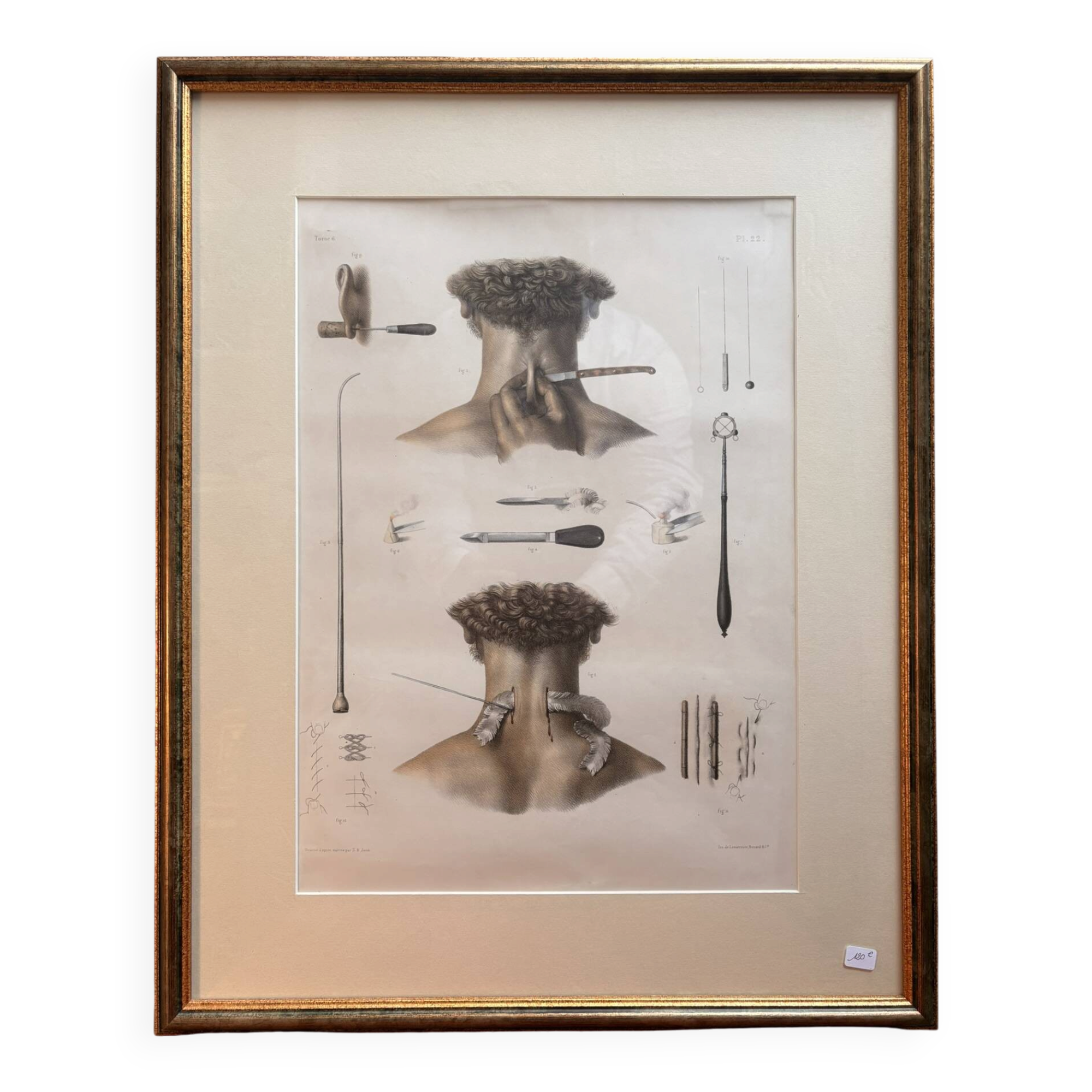 Print Engraving Material Surgery Seton Treatise Anatomy Man BOURGERY