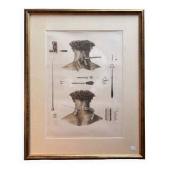 Print Engraving Material Surgery Seton Treatise Anatomy Man BOURGERY