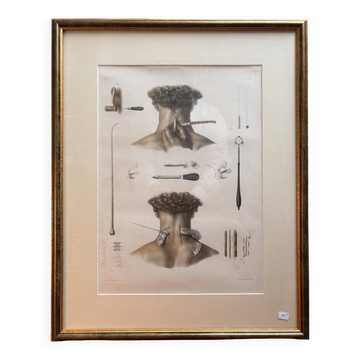 Estampe Gravure Matériel Chirurgie Séton Traité Anatomie Homme BOURGERY