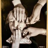 “Schielens Operation (Squint Surgery)” – 1944 Art Photo
