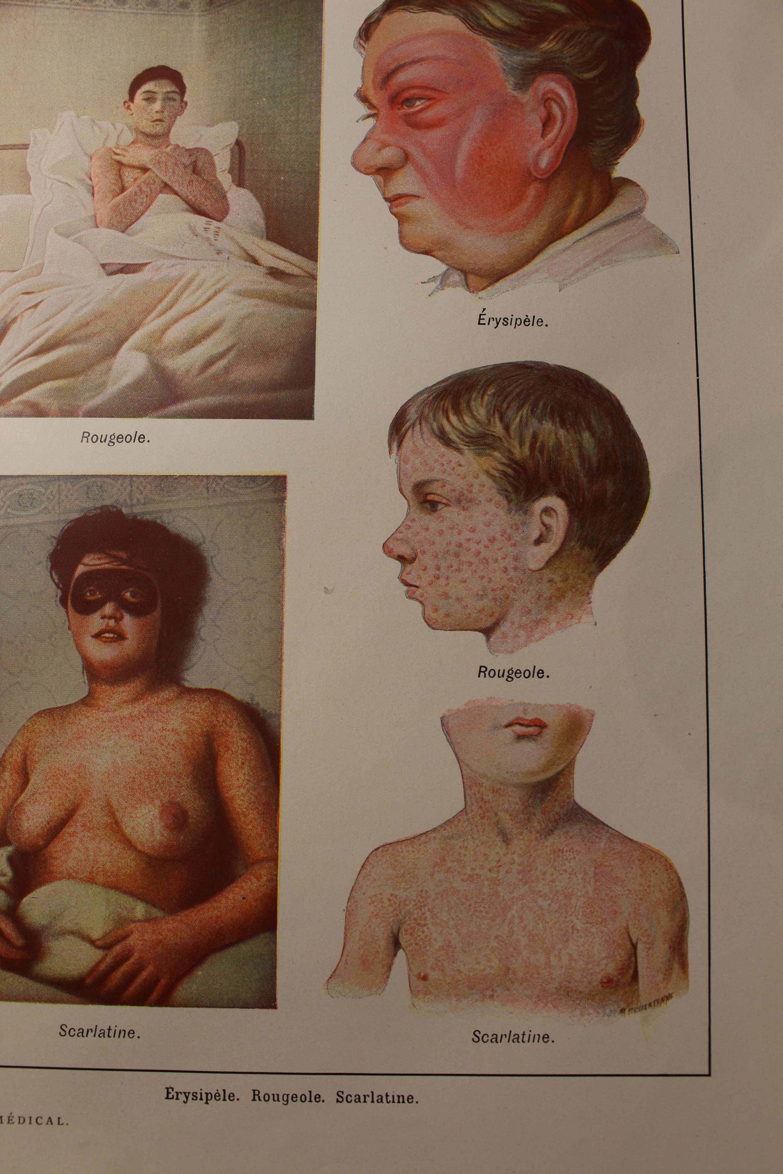 Medical board - anatomy - erysipelas