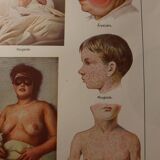 Medical board - anatomy - erysipelas