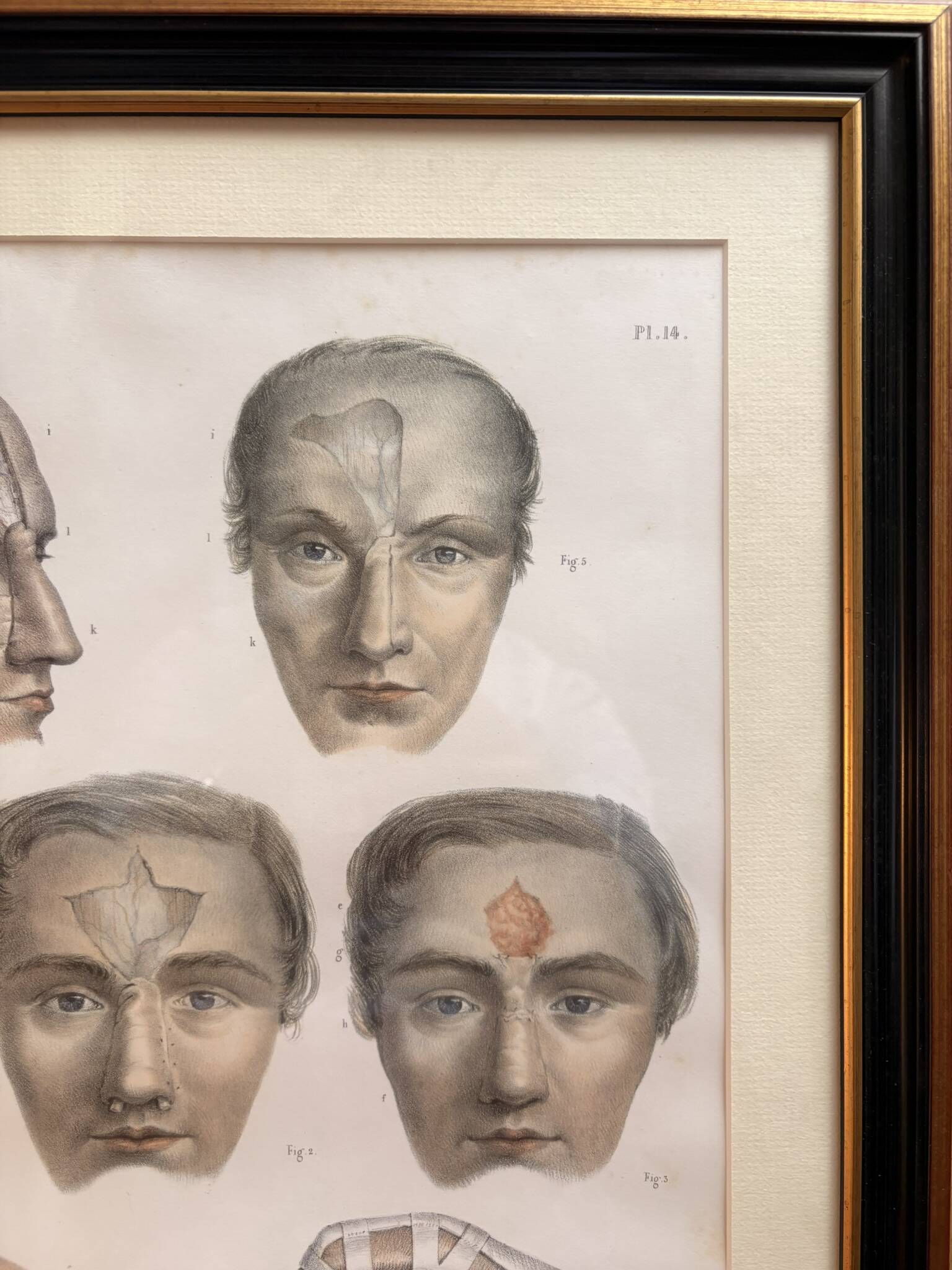 Gravure Plastic Surgery Rhinoplasty NICOLAS Jacob Bourgery Anatomy