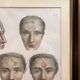 Gravure Chirurgie plastique Rhinoplastique NICOLAS Jacob Bourgery Anatomie