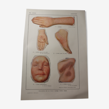 Planche médicale anatomie Lentigo