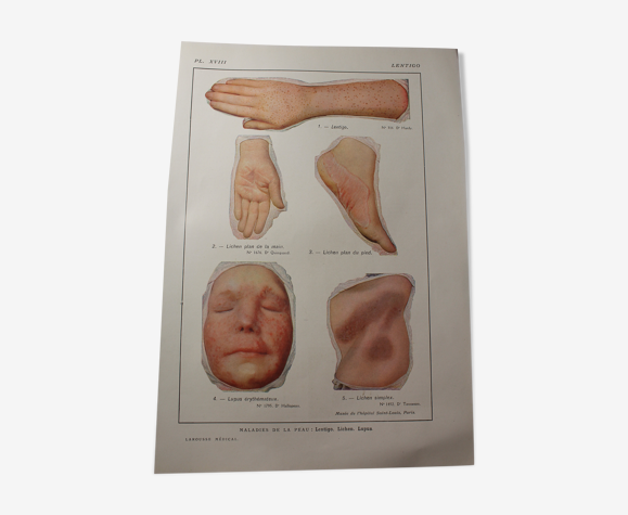 Planche médicale anatomie Lentigo