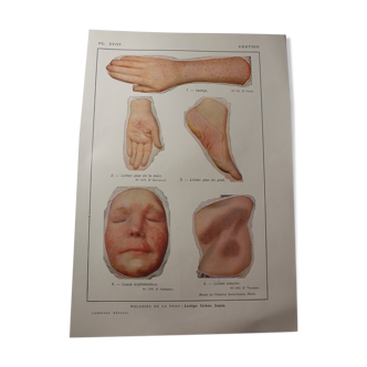 Planche médicale anatomie Lentigo