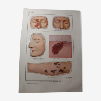 Planche médicale anatomie molluscum