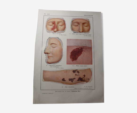 Planche médicale anatomie molluscum