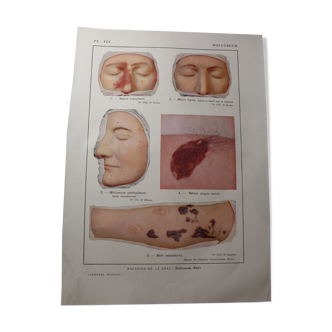Planche médicale anatomie molluscum