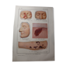 Medical board - anatomy - Molluscum