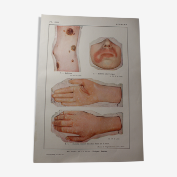 Medical board - anatomy - ecthyma