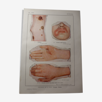 Planche médicale - anatomie - ecthyma