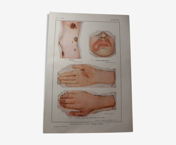 Planche médicale - anatomie - ecthyma