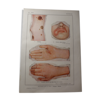 Medical board - anatomy - ecthyma