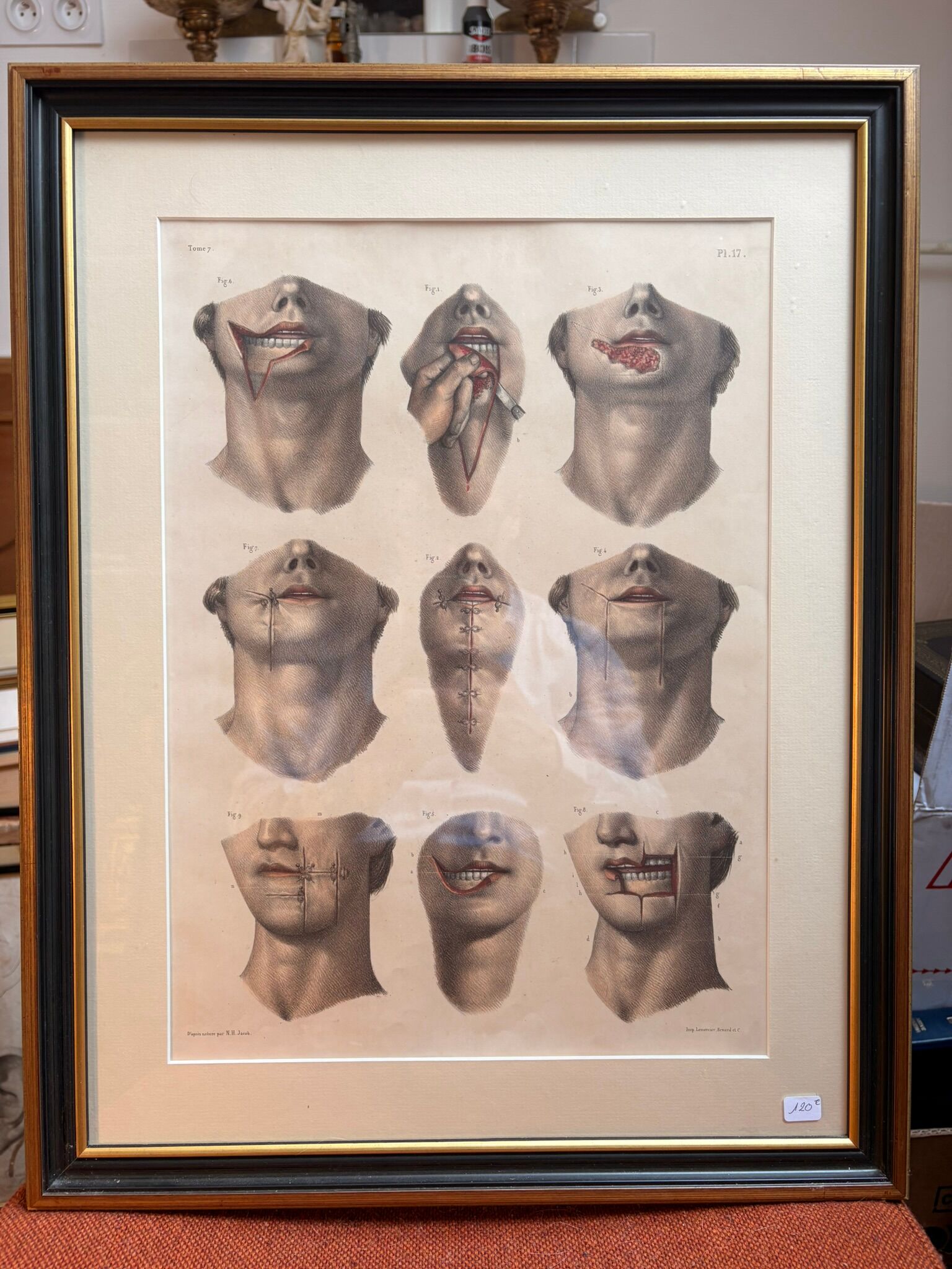 Gravure Cheiloplastic Facial Surgery Anatomy Nicolas Jacob Bourgery