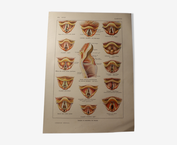 Planche médicale anatomie larynx