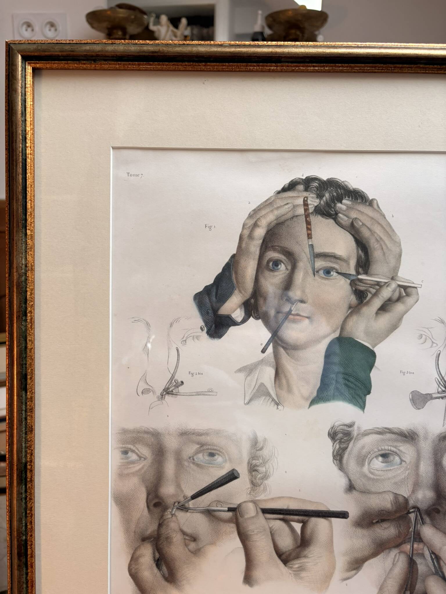 Old Print Engraving 19th Century Anatomy Surgery Atlas Bourgery Nicolas Jacob