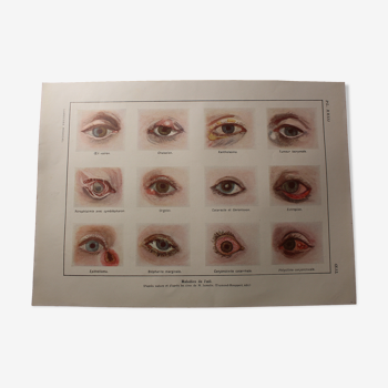 Planche médicales anatomie maladies de l'oeil
