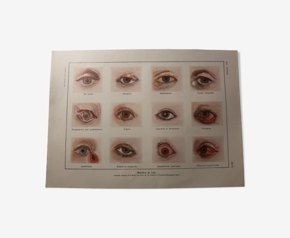 Planche médicales anatomie maladies de l'oeil